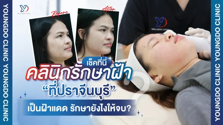 เช็กที่นี่ คลินิกรักษาฝ้าที่ปราจีนบุรี เป็นฝ้าแดด รักษายังไงให้จบ?
