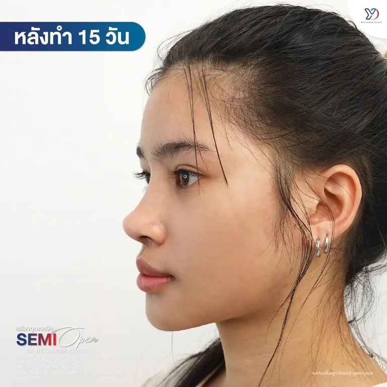 หลังทำเปลี่ยนลุคใน 15 วัน