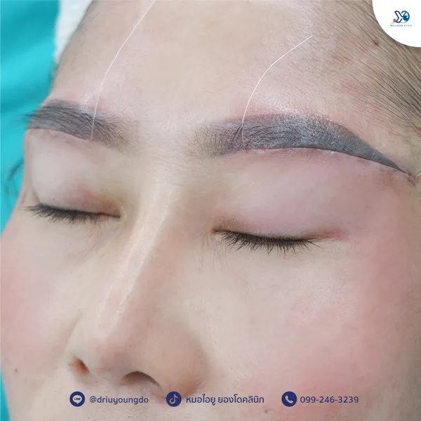 หลังทำ Subbrow Lift