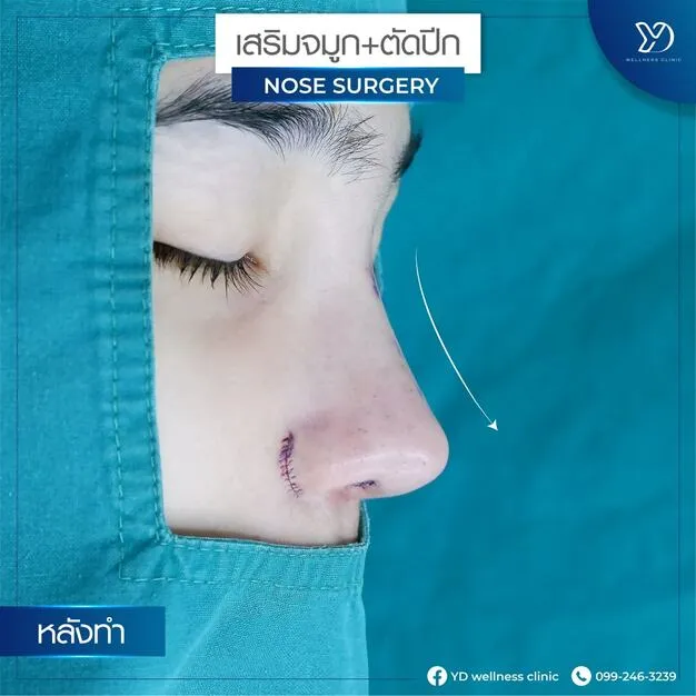 ผลลัพธ์หลังตัดปีกจมูก มุมข้าง