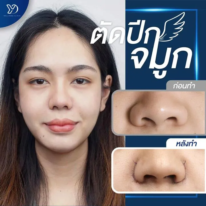 ก่อน–หลัง ตัดปีกจมูก