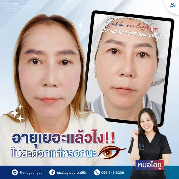 ยกหางตา ลดอายุ ไม่ง้อความแก่