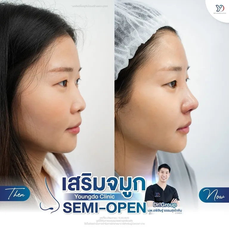 ก่อน-หลังเสริมจมูก โด่งขึ้นชัดเจน