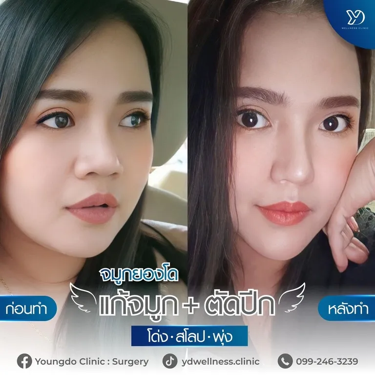 ก่อน–หลัง แก้จมูก+ตัดปีก