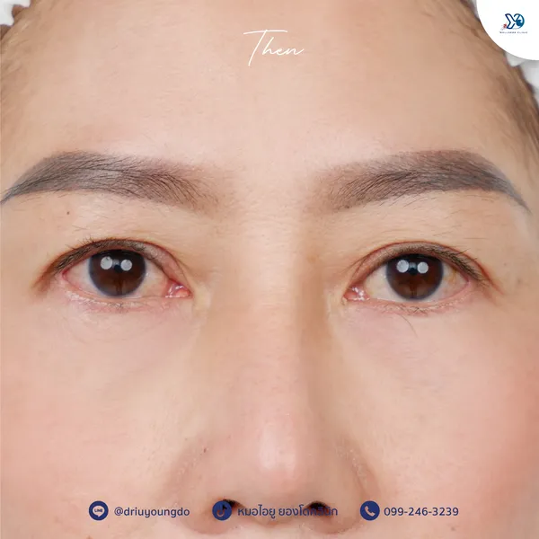 ก่อนทำ Subbrow Lift