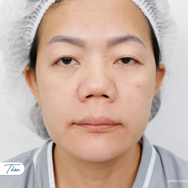 ก่อนทำ Subbrow Lift