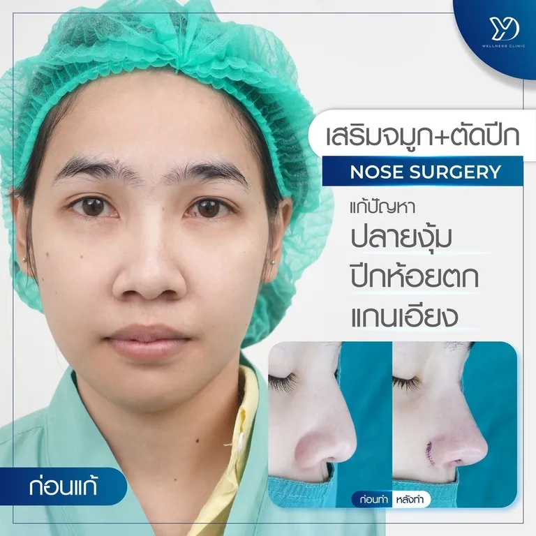 แก้จมูกเบี้ยว+ปลายห้อย