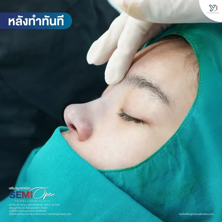เสริมจมูกเห็นผลทันทีหลังทำ
