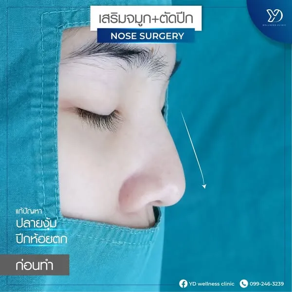 ปลายจมูกงุ้มก่อนแก้