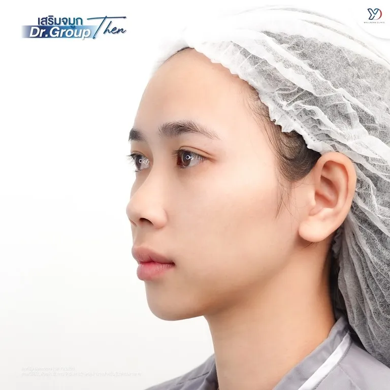 รูปก่อนทำจมูก