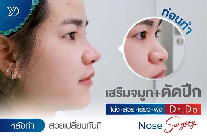 เสริมจมูก+ตัดปีก เปลี่ยนหน้าเป๊ะ