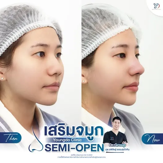 เสริมจมูกเทคนิคกึ่งเปิด-ก่อนและหลังทำ