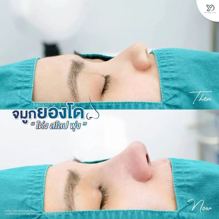 แปลงโฉมจมูกทรงสโลป
