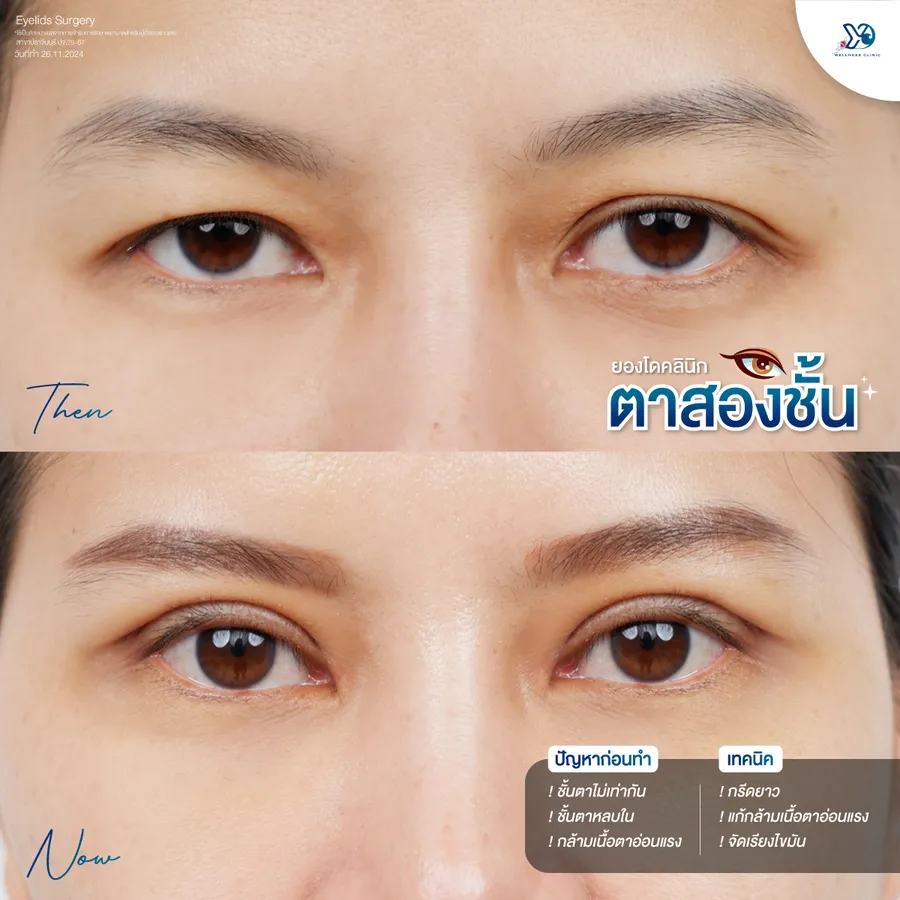 ก่อน-หลัง แก้กล้ามเนื้อตาอ่อนแรง