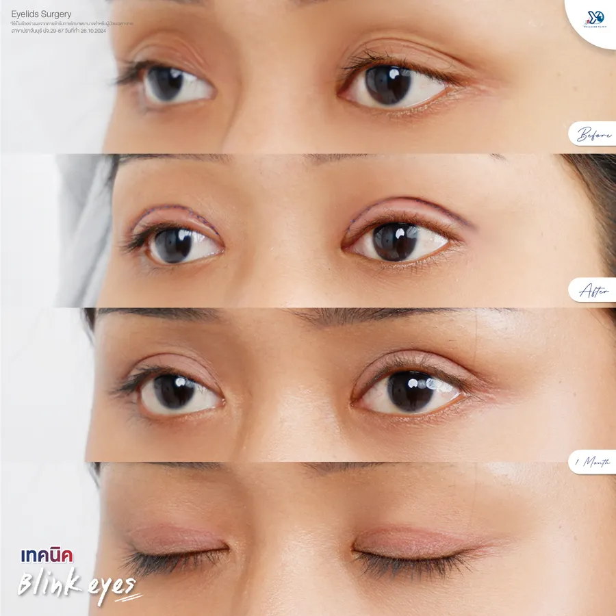 พัฒนาการหลังทำตา เทคนิค Blink Eyes