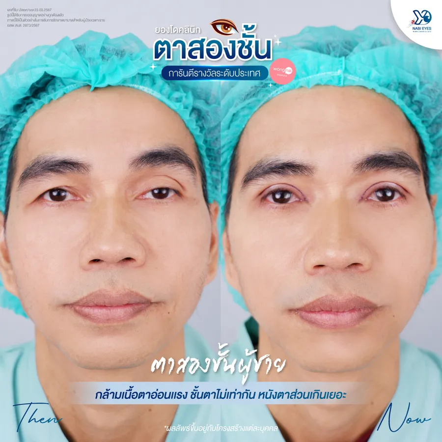 การศัลยกรรมตาสองชั้นสำหรับผู้ชายที่มีอายุ หนังตาตก ก่อนและหลัง