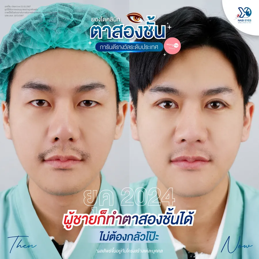 การศัลยกรรมตาสองชั้นสำหรับผู้ชายที่มีชั้นตาไม่ชัด ตาไม่เท่ากัน ก่อนและหลัง