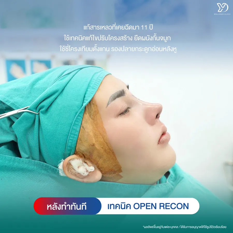หลังแก้จมูกด้วยเทคนิค Open Recon ทันที