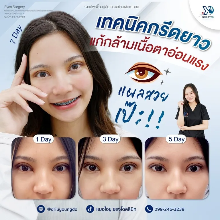 เทคนิคกรีดยาวแก้กล้ามเนื้อตาอ่อนแรง