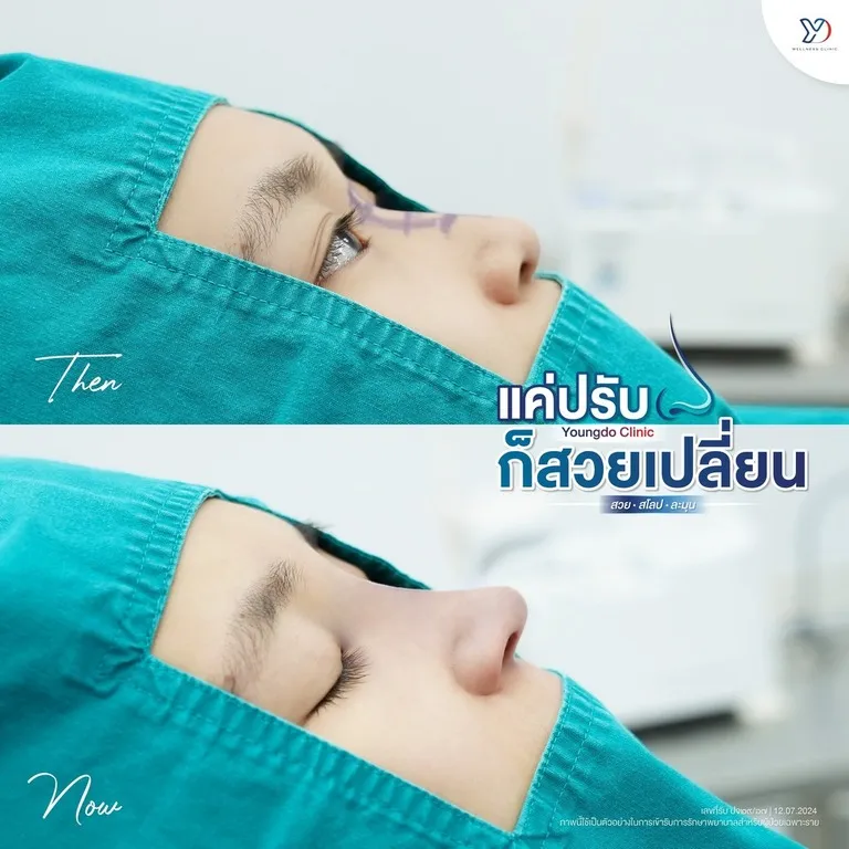 ก่อน-หลังปรับทรงจมูก