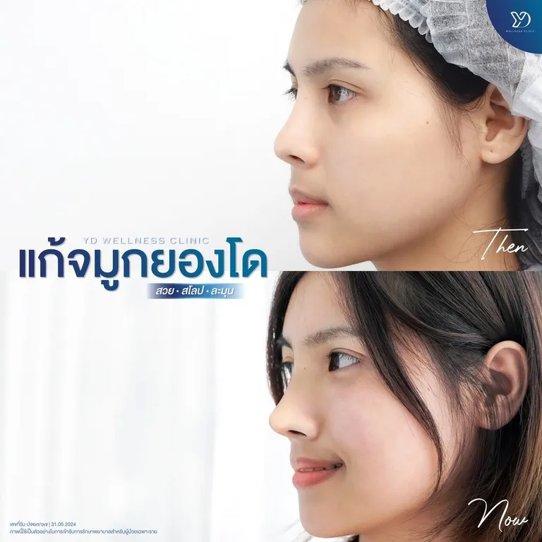 แก้จมูกที่ยองโดคลินิก