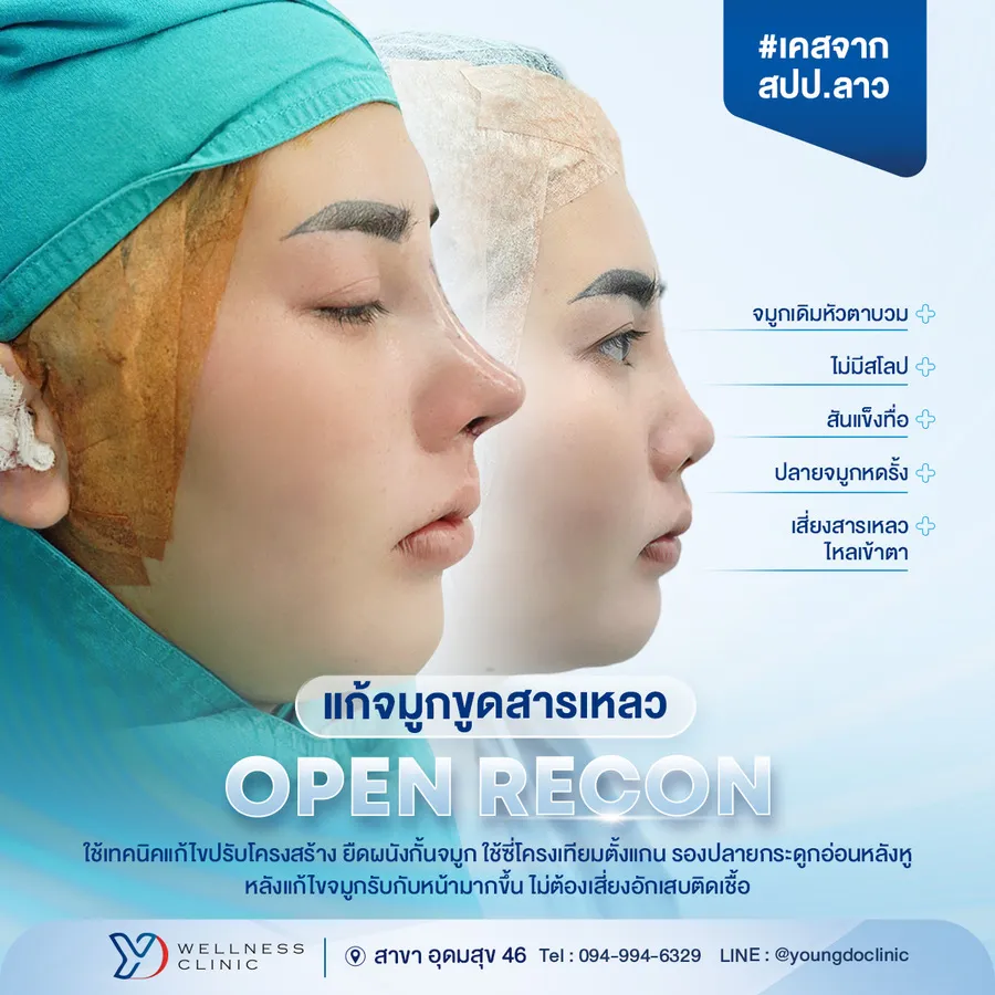 แก้จมูกขูดสารเหลวด้วยเทคนิค Open Recon