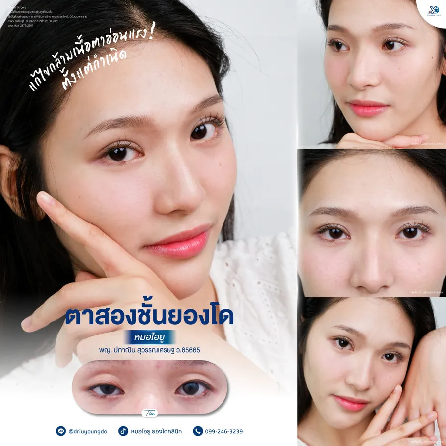 รีวิวตาสองชั้น ยองโด แก้กล้ามเนื้อตาอ่อนแรง