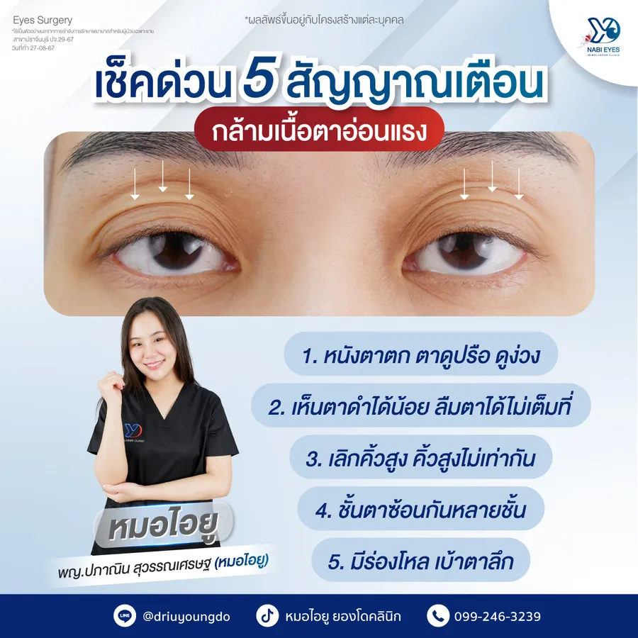 เช็ก 5 สัญญาณเตือน กล้ามเนื้อตาอ่อนแรง