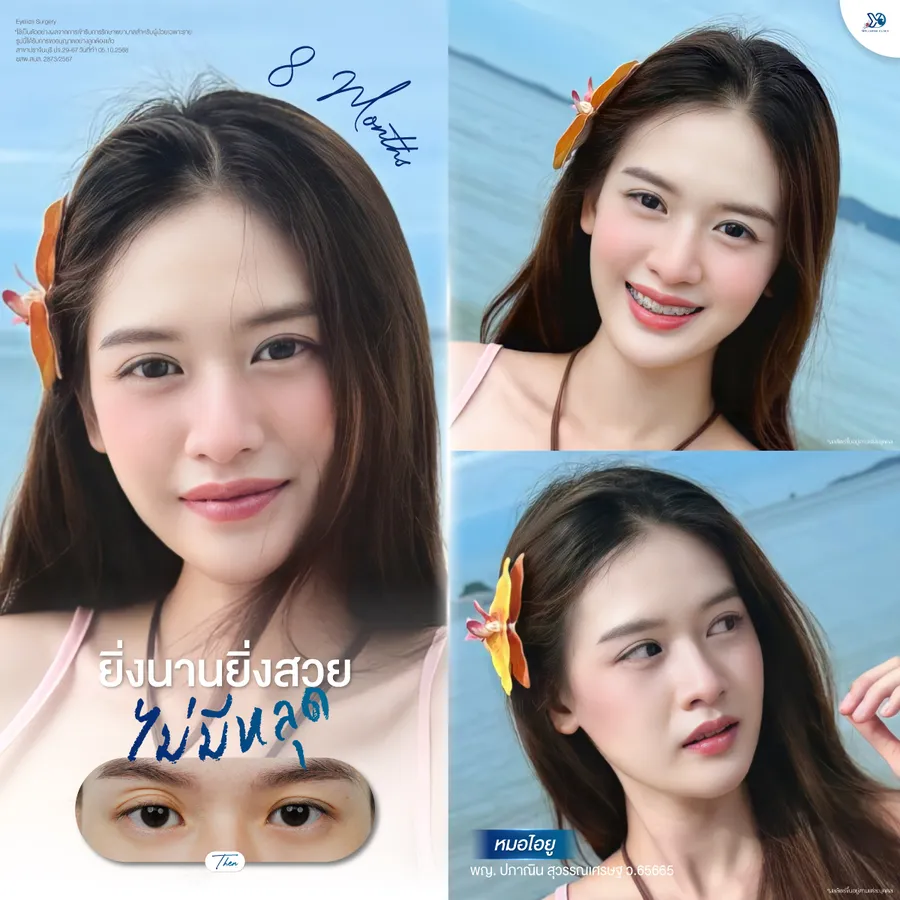 รีวิวตาสองชั้นยองโด-01