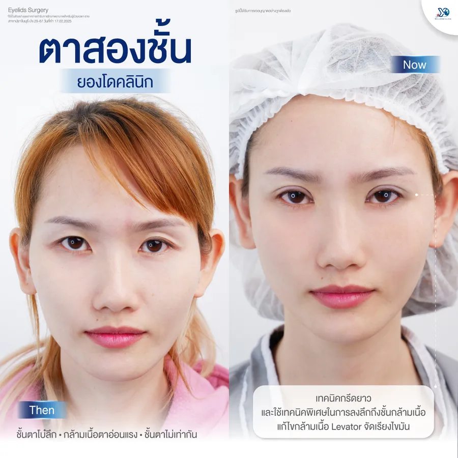 รีวิวตาสองชั้นยองโด-10