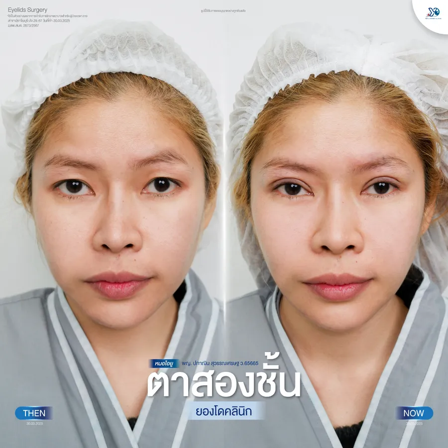 รีวิวตาสองชั้นยองโด-13