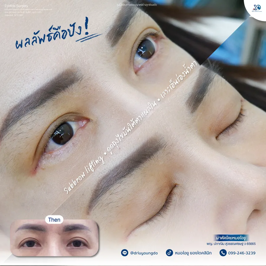 รีวิวตาสองชั้นยองโด-14
