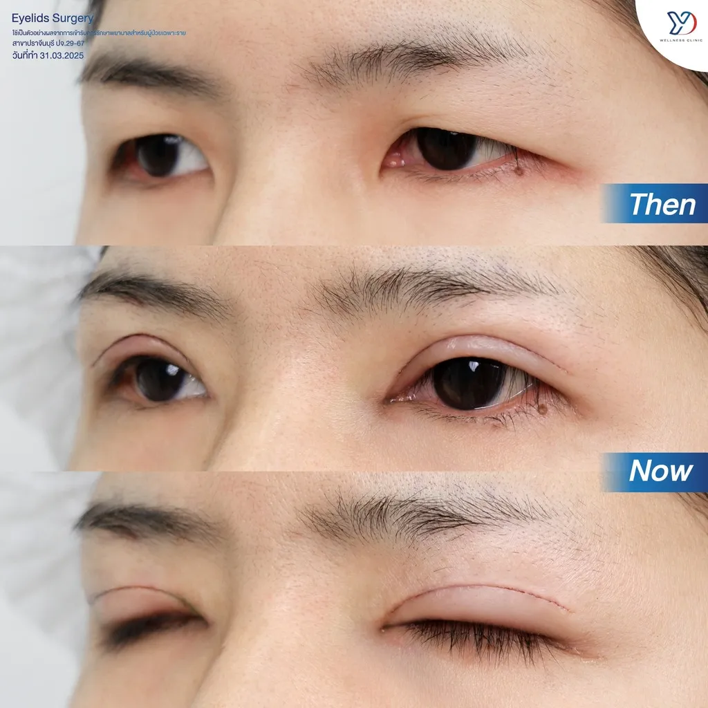 รีวิวตาสองชั้นยองโด-15
