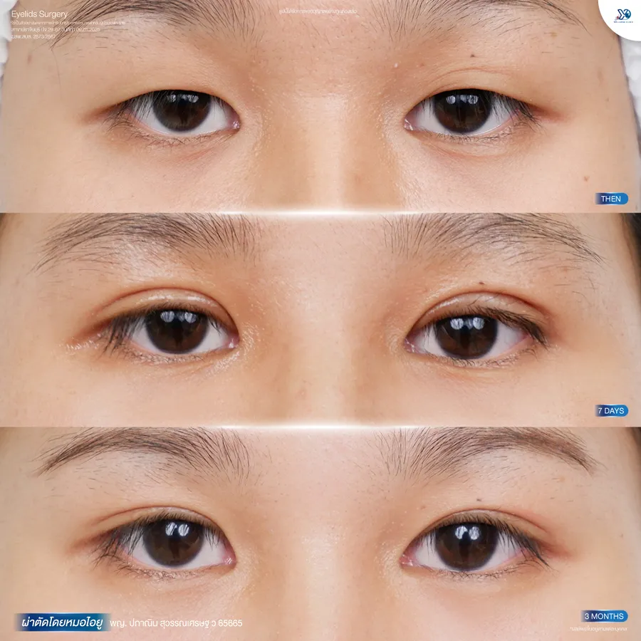 รีวิวตาสองชั้นยองโด-16