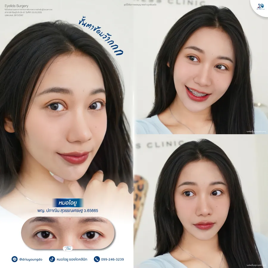 รีวิวตาสองชั้นยองโด-17