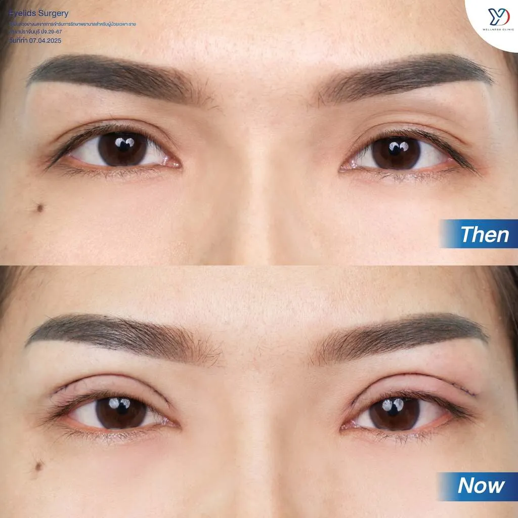 รีวิวตาสองชั้นยองโด-18