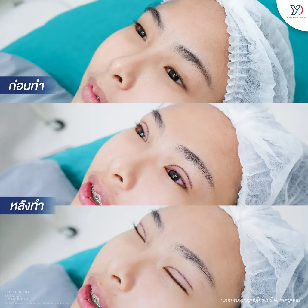 รีวิวตาสองชั้นยองโด-19