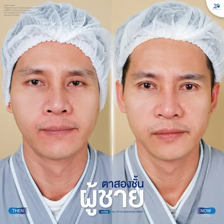 รีวิวตาสองชั้นยองโด-02