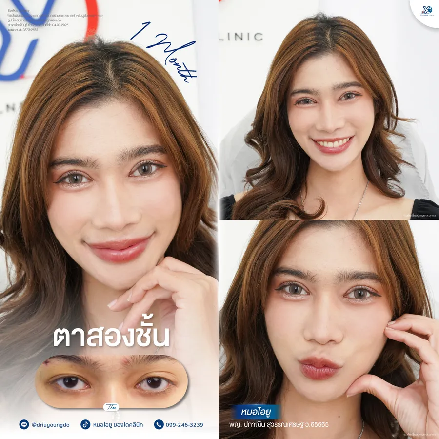 รีวิวตาสองชั้นยองโด-20