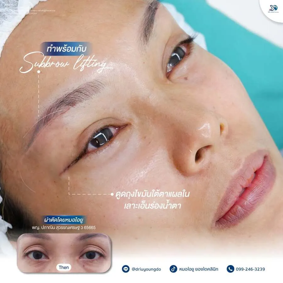 รีวิวตาสองชั้นยองโด-21