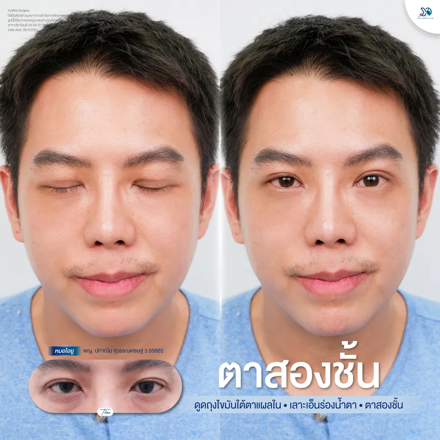 รีวิวตาสองชั้นยองโด-22