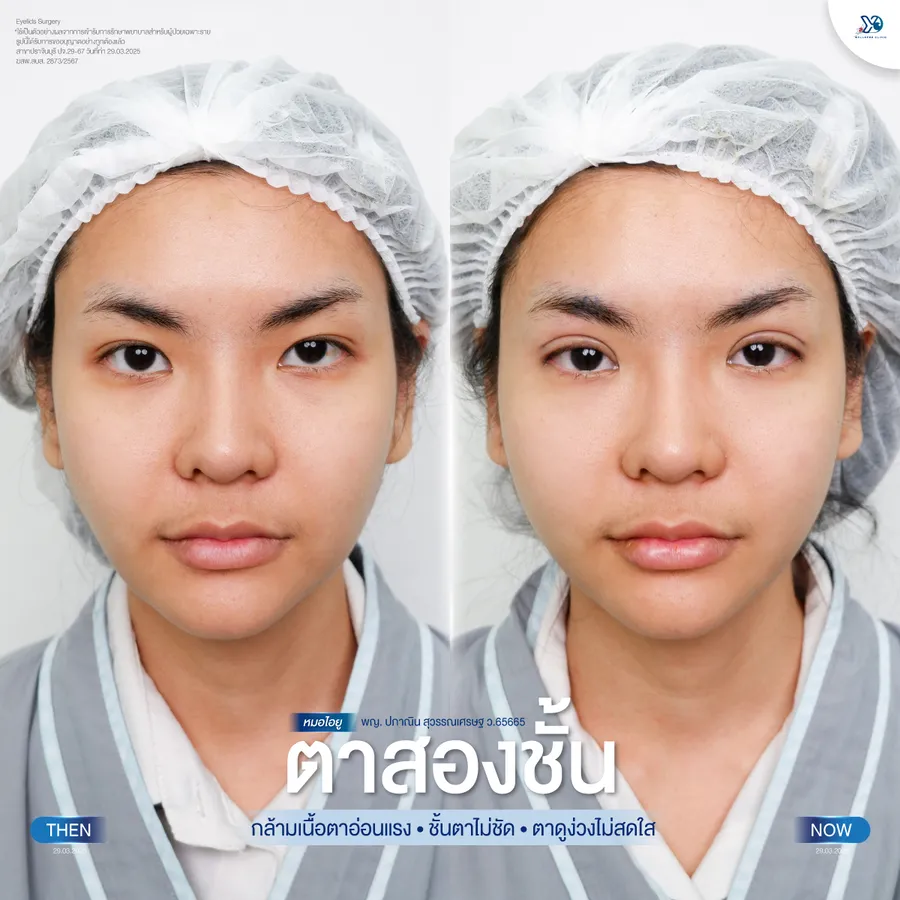 รีวิวตาสองชั้นยองโด-23