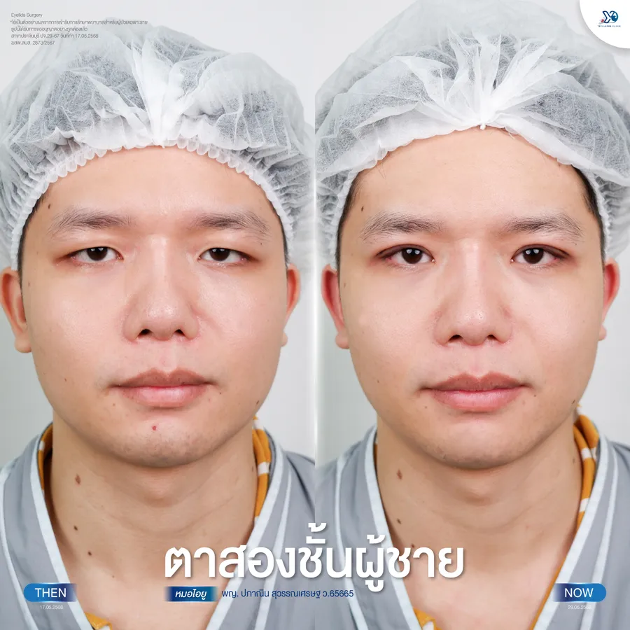 รีวิวตาสองชั้นยองโด-25