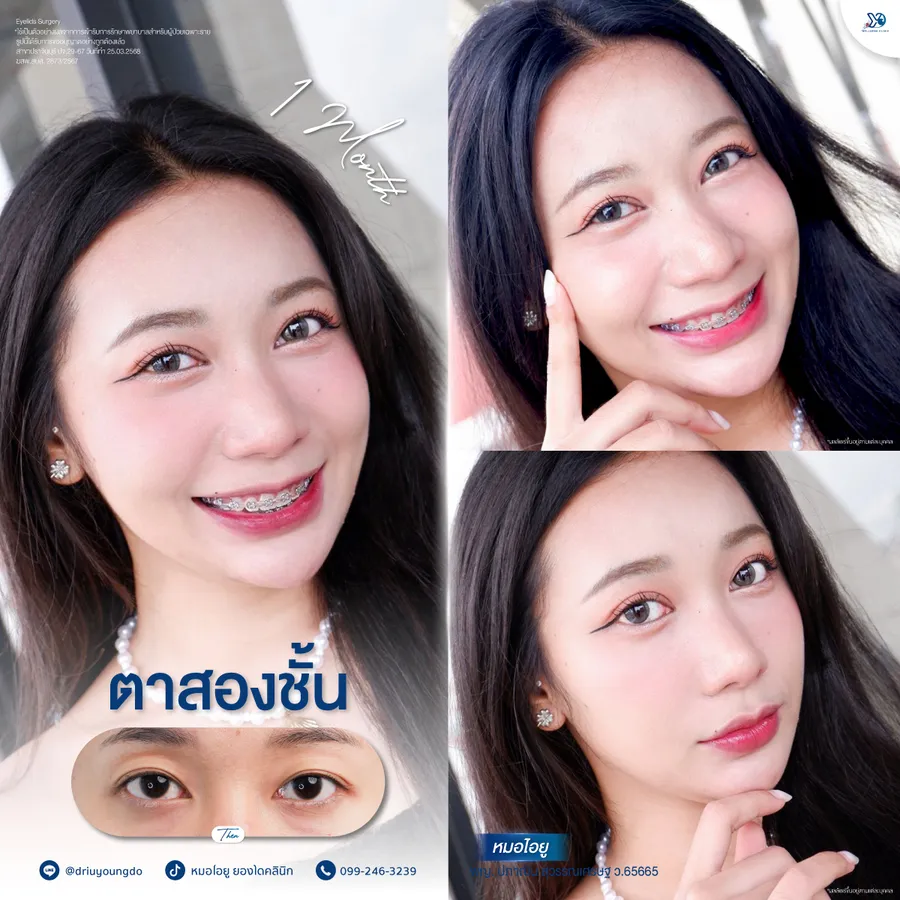 รีวิวตาสองชั้นยองโด-26
