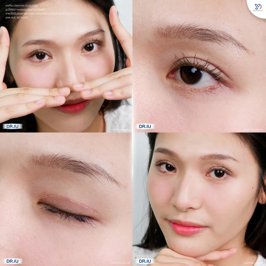 รีวิวตาสองชั้นยองโด-27