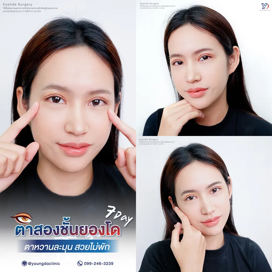รีวิวตาสองชั้นยองโด-28