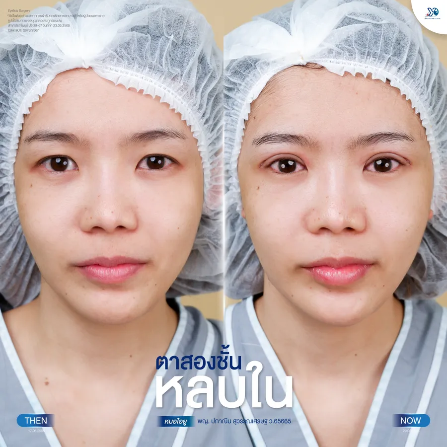 รีวิวตาสองชั้นยองโด-29