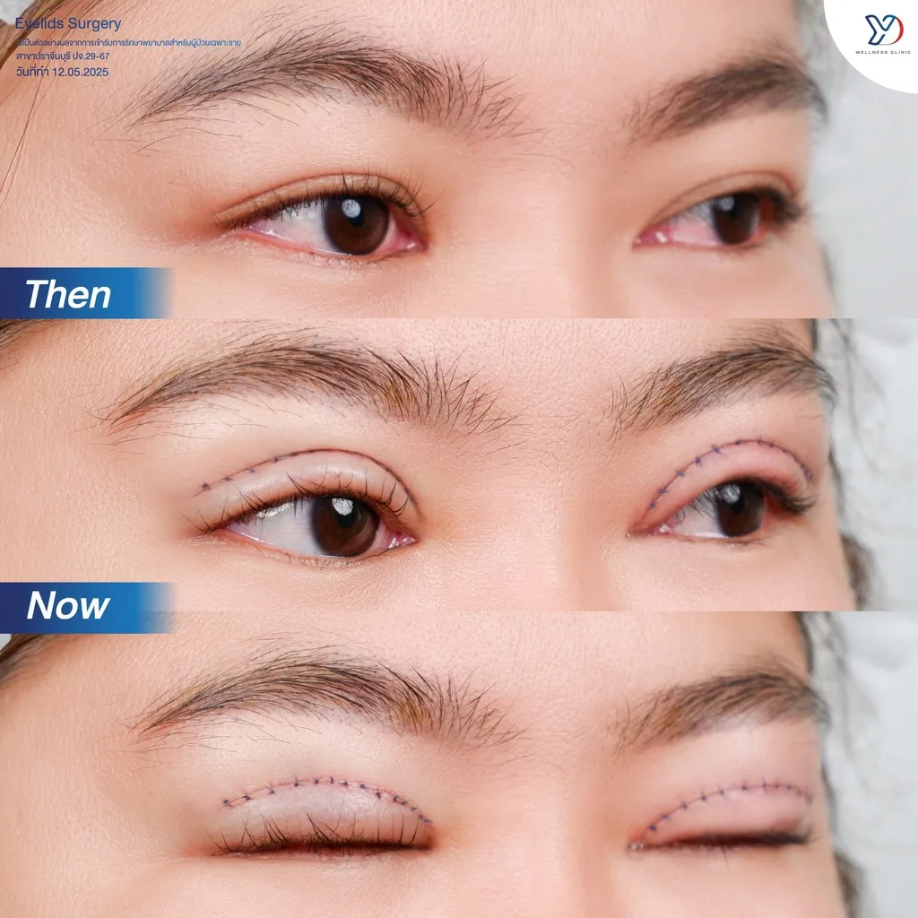 รีวิวตาสองชั้นยองโด-03