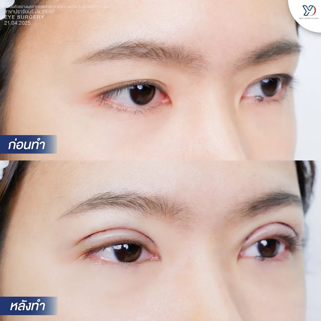 รีวิวตาสองชั้นยองโด-31