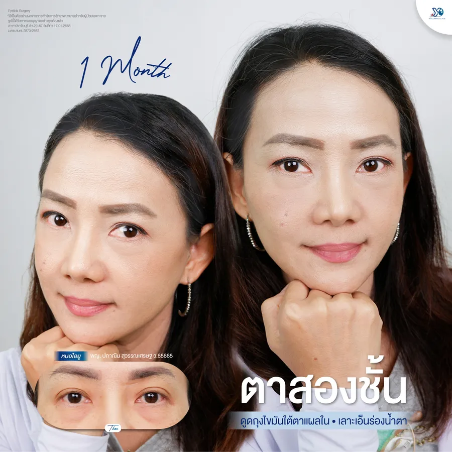 รีวิวตาสองชั้นยองโด-33